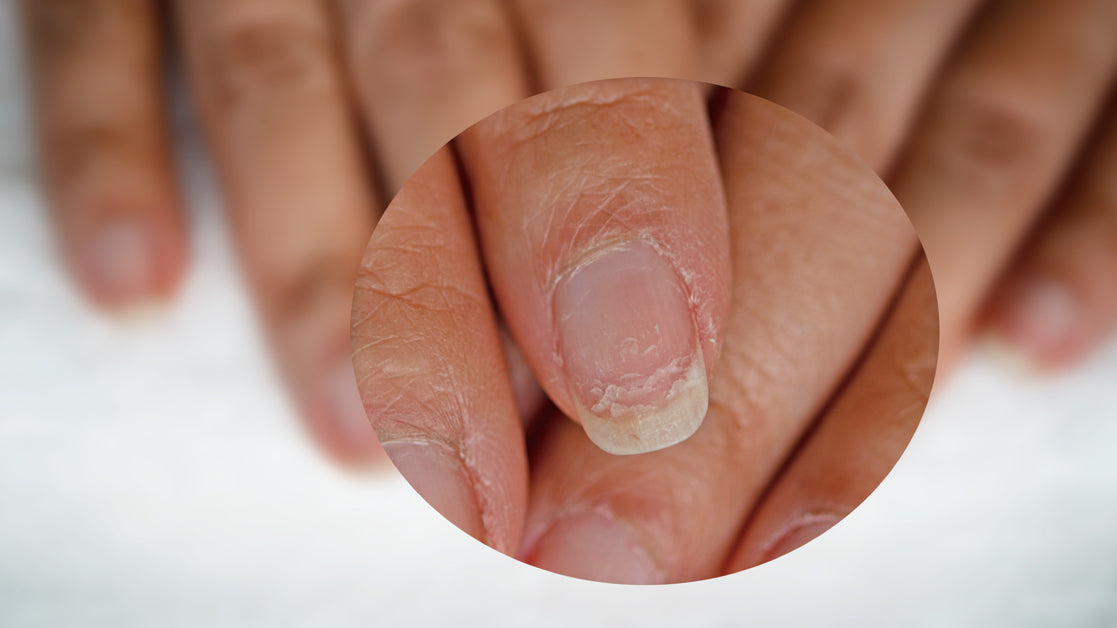 What Causes Brittle Nails? How Do You Treat Them?