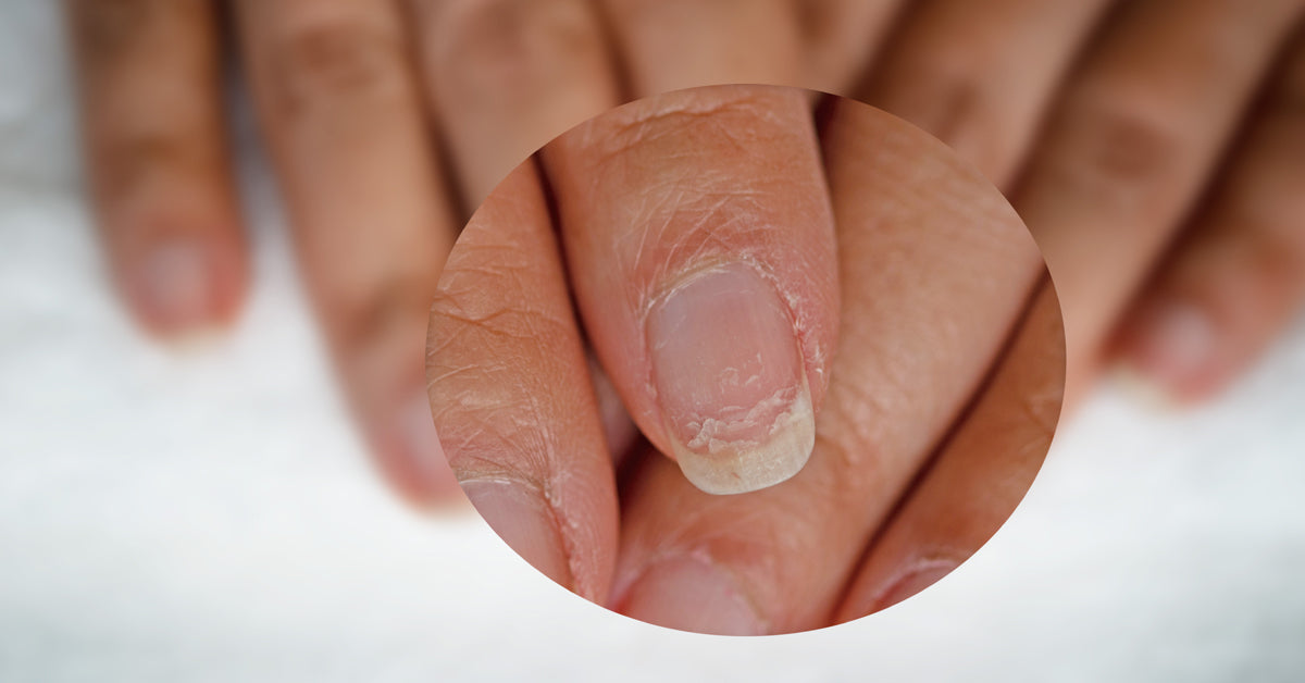 Detection of Disease Through Nails | Ekohadiprabowo's Blog